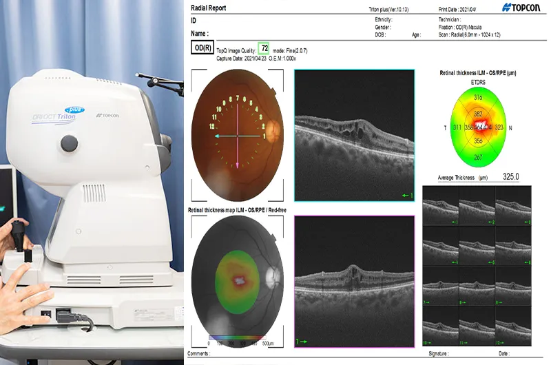 OCT（光干渉断層計）